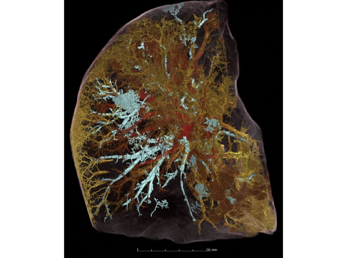 Covid-19’dan ölen bir kişinin akciğerleri görüntülendi
