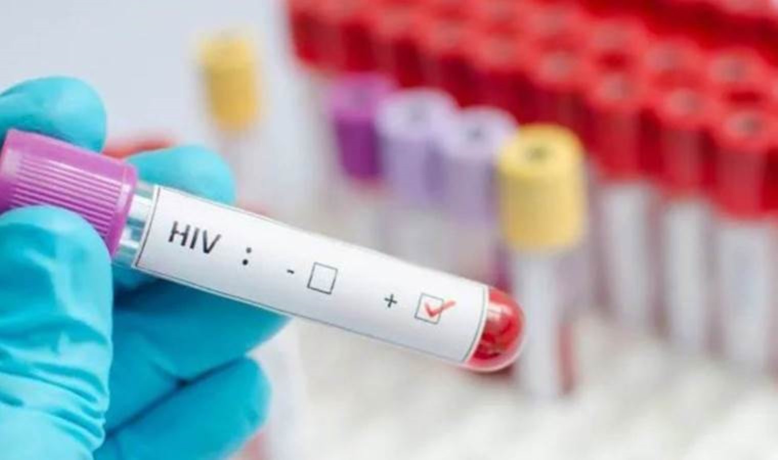 Hiv Erken Tan Ve Tedaviyle Y Netilebilir Bir Hastal K Son Dakika