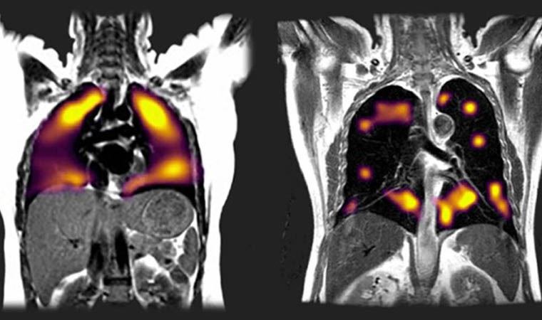 Covid-19: Yeni tarama tekniği, akciğerlerdeki hasarı 'gösterdi'