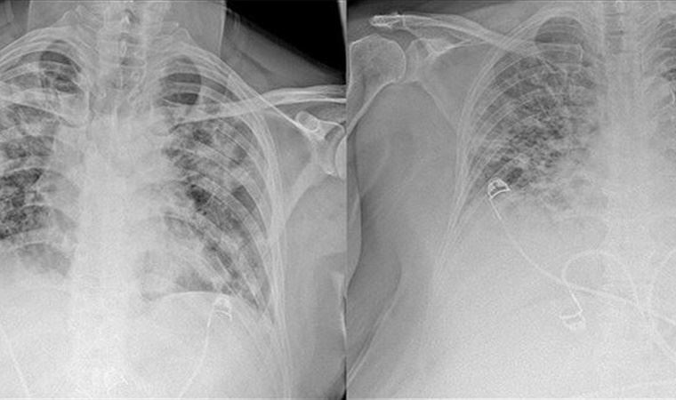 Koronavirüsün akciğerdeki ağır tahribatı, hastaların tomografi görüntülerine yansıdı