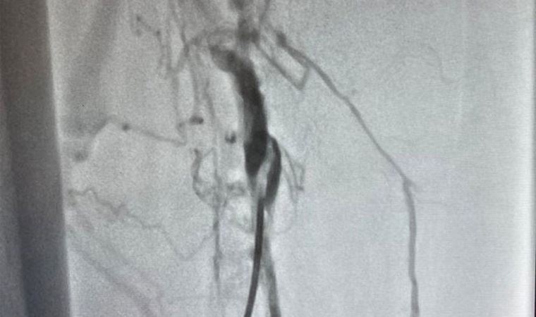 İlk defa ameliyatsız yöntemle toplardamarda oluşan pıhtı çıkartıldı