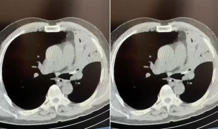 Öksürük şikayetiyle gitti: 5 yıldır akciğerine saplı kemikle yaşadığını öğrendi