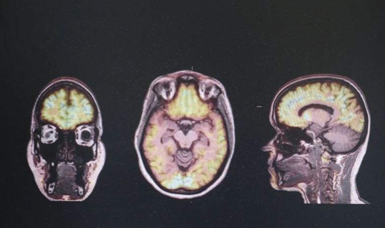 Alzheimer'ın yeni bir nedeni keşfedildi