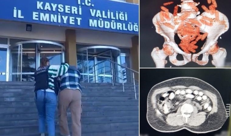 Midesinden yaklaşık 1 kilo uyuşturucu çıktı