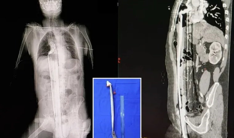 Ölümden 'mucize' kurtuluşu doktorları şaşırttı: 91 cm uzunluğunda demir çubuk çıkarıldı