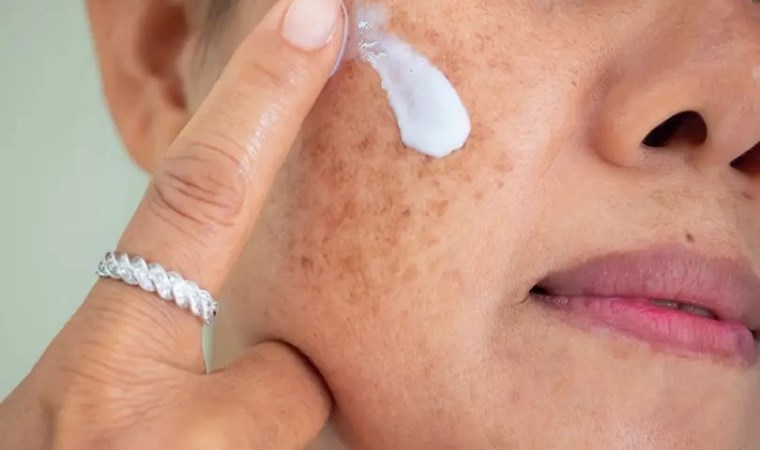 Dermatoloji uzmanından güneş ışınları uyarısı: Hastalıkları tetikliyor