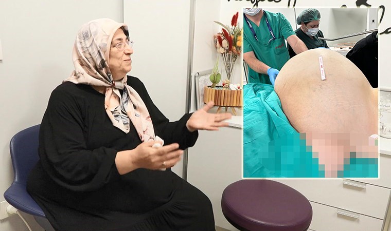 Doktorları bile şaşırttı: Fobisi yüzünden hastaneye gitmeyen kadının yumurtalıklarından 23 kiloluk kitle çıkarıldı