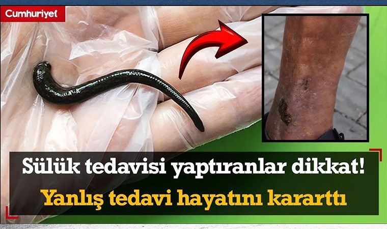 Sülük tedavisi yaptıranlar dikkat!