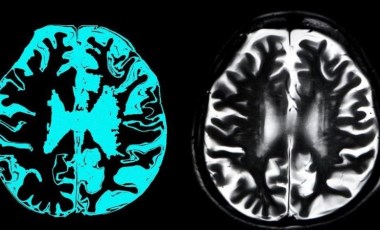 AB, Alzheimer tedavisi için geliştirilen ilaca kullanım onayı vermedi