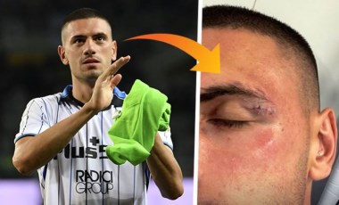 Salernita - Atalanta maçında milli futbolcu Merih Demiral, kanlar içinde kaldı