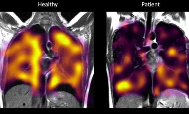 Uzun Covid: Ksenon gazı ile yapılan taramalarda gizli akciğer hasarı tespit edilebildi