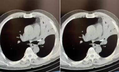 Öksürük şikayetiyle gitti: 5 yıldır akciğerine saplı kemikle yaşadığını öğrendi