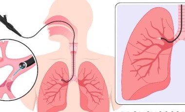 Otomatik iğne deride özgürce hareket edebiliyor! Aktif bir akciğerde test edildi