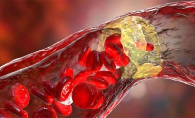 Kolesterol yüklü damarların virüsle enfeksiyona daha açık hale geldiği ispatlandı