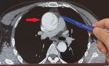 Acildeki doktorun dikkati sayesinde kurtuldu... Mide ağrısı sandı, aort damarında 'yırtık' çıktı