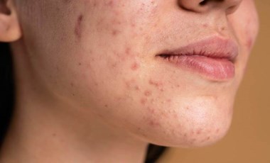 Dermatologlar anlattı: Sivilcelerinizden nasıl kurtulursunuz?