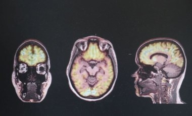 Alzheimer'ın yeni bir nedeni keşfedildi