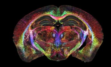 Bu teknoloji beyin görüntülemede devrim yaratacak! Alzheimer, Parkinson ve İnme gibi hastalıklarda erken teşhis imkanı