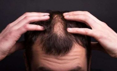 Işın Karaca'nın hastalığı ne? Alopesi Üniversalis hastalığı nedir, belirtileri neler? Alopesi Üniversalis hastalığı tedavisi var mı?