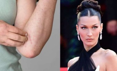 Lyme hastalığı nedir? Bella Hadid'in hastalığı Lyme'nin belirtileri nedir? Lyme hastalığının tedavisi var mı?