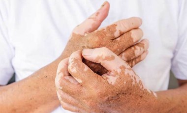 Stres ve travmalar vitiligo hastalığını tetikliyor