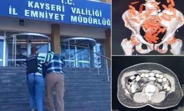 Midesinden yaklaşık 1 kilo uyuşturucu çıktı