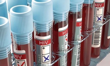 HIV virüsü nedir,  belirtileri nelerdir?  HIV Enfeksiyonu (AIDS) nasıl bulaşır?