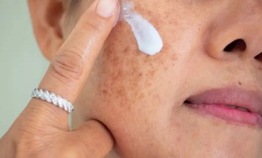 Dermatoloji uzmanından güneş ışınları uyarısı: Hastalıkları tetikliyor