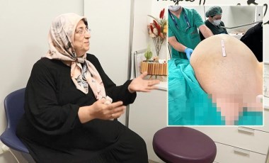 Doktorları bile şaşırttı: Fobisi yüzünden hastaneye gitmeyen kadının yumurtalıklarından 23 kiloluk kitle çıkarıldı