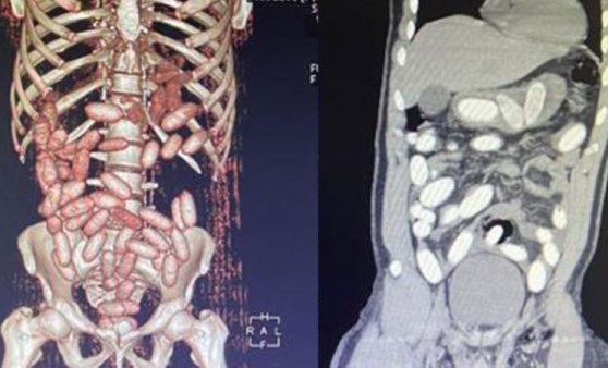 7 yolcunun midesinden 11 kilo kokain çıktı